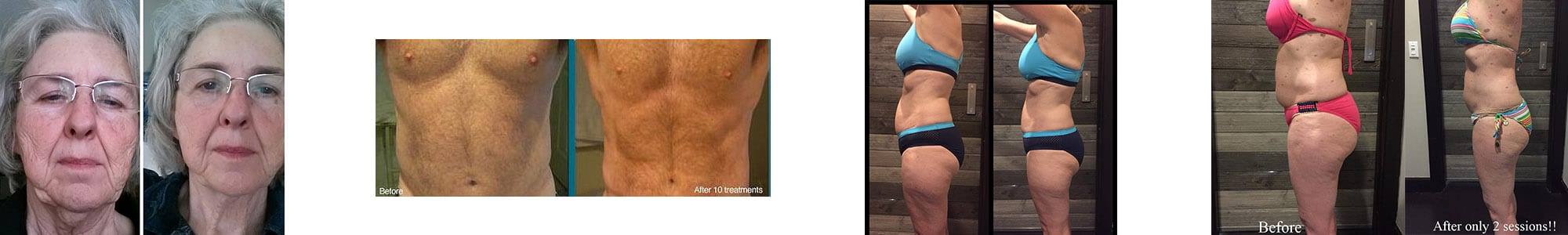 Chiropractic Jupiter FL Lipo Melt Hero Chiropractic Jupiter FL Lipo Melt Hero