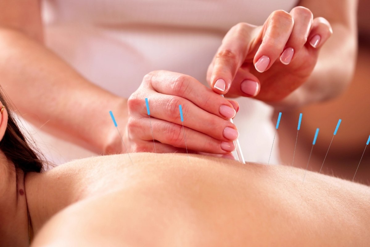 Acupuncture & Dry Needling